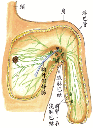 副乳的危害,腋下淋巴结堵塞!